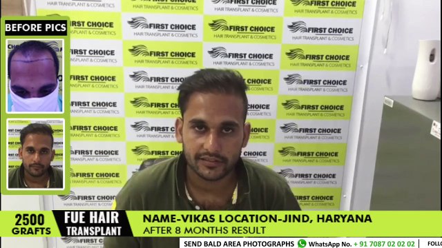 6 months Hair Transplant Results - 2500 grafts hair transplant in Ludhiana - Fue | FCHTC