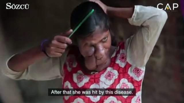 Yüzündeki tümör evlilik hayallerini suya düşürdü