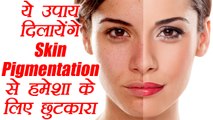 Skin Pigmentation से हमेशा के लिए छुटकारा दिलायेंगे ये उपाय | Home Remedies | Boldsky