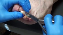 trimming nails in podiatry office