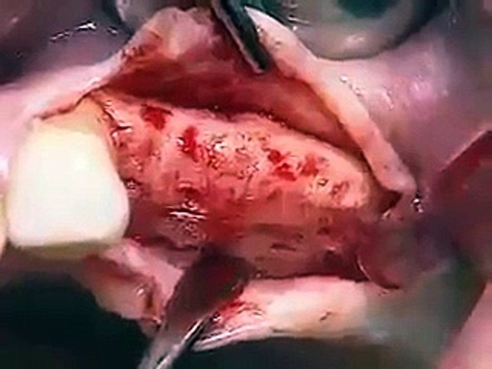 Live Operation or Surgery of Teeth