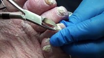 Thick Fungal Nails and Wound on Diabetic Patient with Lymphedema