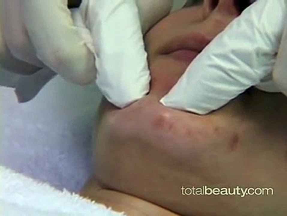 How to Extr a Blackhead from Your Skin Properly
