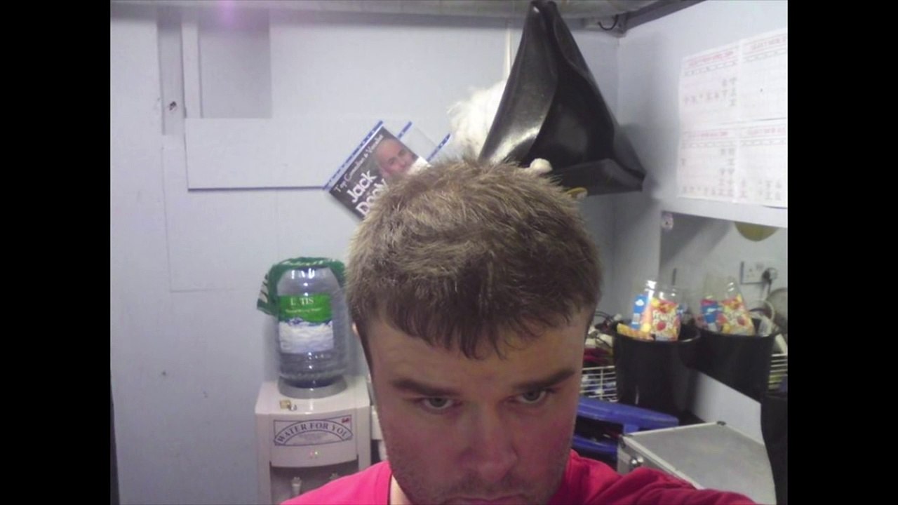 Hair Transplant Results -- 3500 FUE Grafts - Alvi Armani