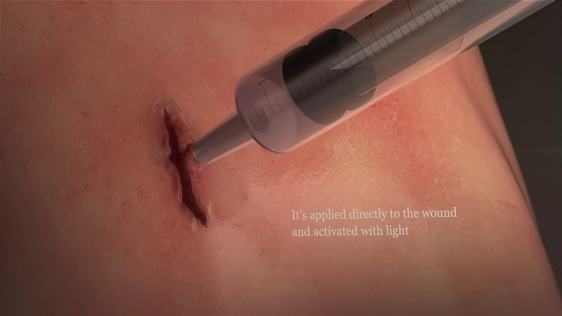 DermaClip, para cerrar heridas sin puntos de sutura - Vídeo Dailymotion