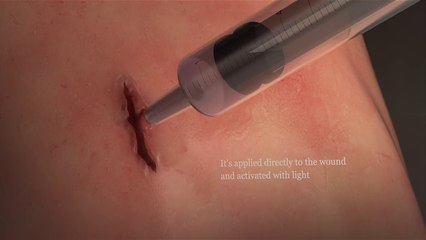Este pegamento cierra las heridas en 60 segundos