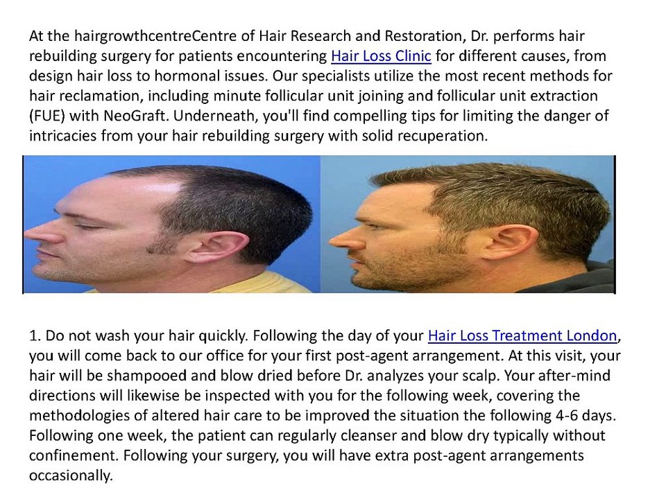 5_Tips_For_Recovering_From_Hair_Transplant_Surgery
