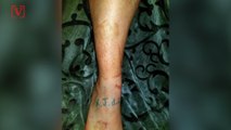 Father Gets Replica of Son's Burn Scars Tattooed on His Leg