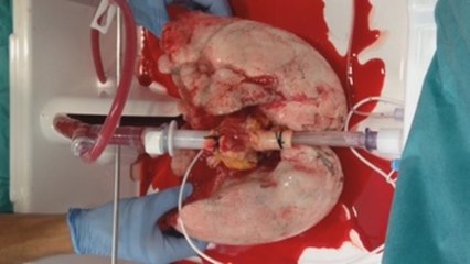 'Ex Vivo', la máquina que da un respiro al trasplante pulmonar