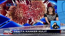 Derita Kanker Kulit di Wajah