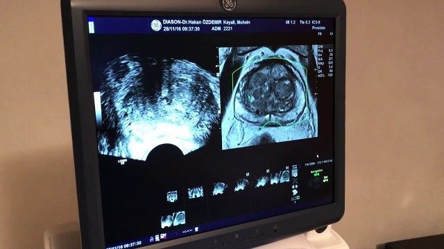 Füzyon Biyopsi ile prostat kanserinde erken tanı