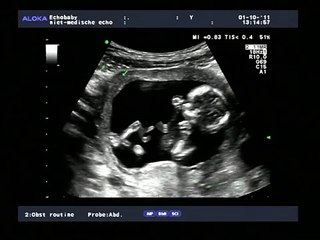2D en 3D-echo 13 weken meisjes