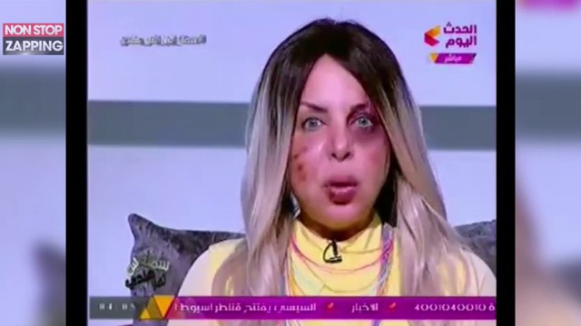 Battue par son mari, une présentatrice égyptienne anime son émission le visage tuméfié (Vidéo)