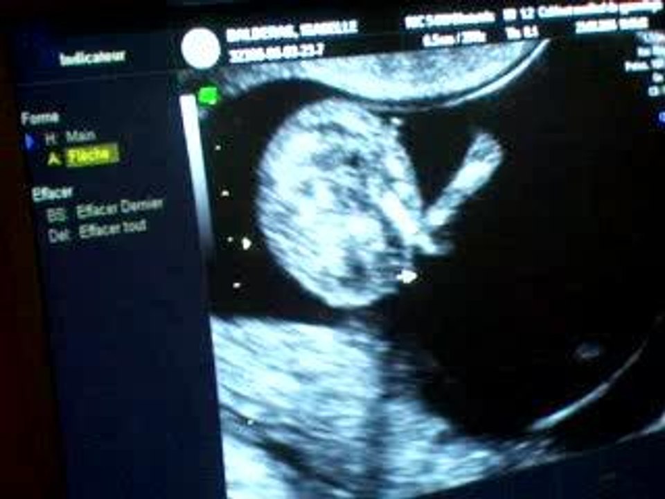 échographie 12 semaines