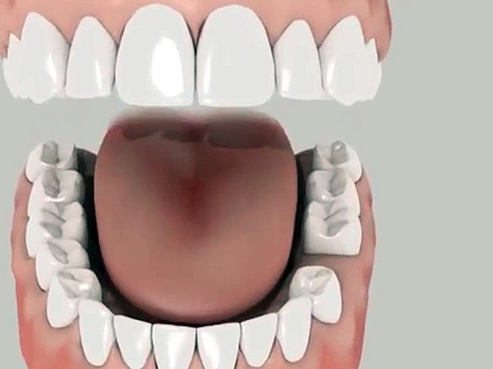Dental Bridge animation