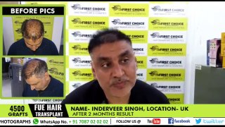 Hair Transplant in Ludhiana - Patient's reviews - results after 6 months | fchtc.in