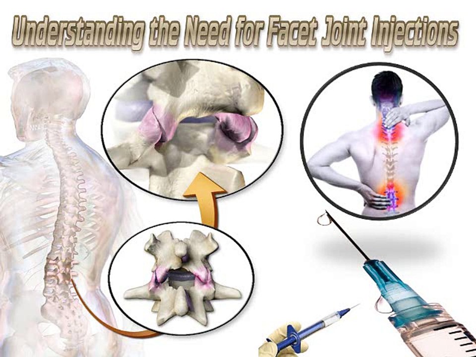 Understanding the Need for Facet Joint Injections