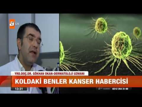 Koldaki benler kanser habercisi - atv Gün Ortası Bülteni