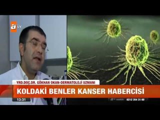 Koldaki benler kanser habercisi - atv Gün Ortası Bülteni