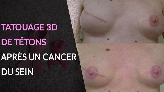 Le tatouage 3D de reconstruction après un cancer du sein