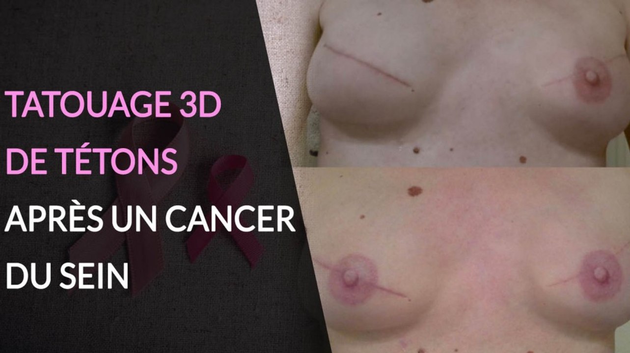 Le tatouage 3D de reconstruction après un cance...