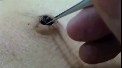 Navel stone from a dirty bellybutton