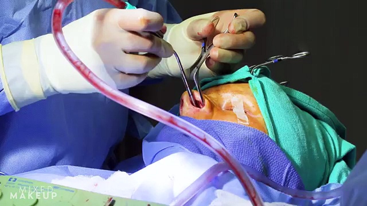 Rhinoplasty to Fix a Deviated Septum | PLASTIC with Dr. Dhir