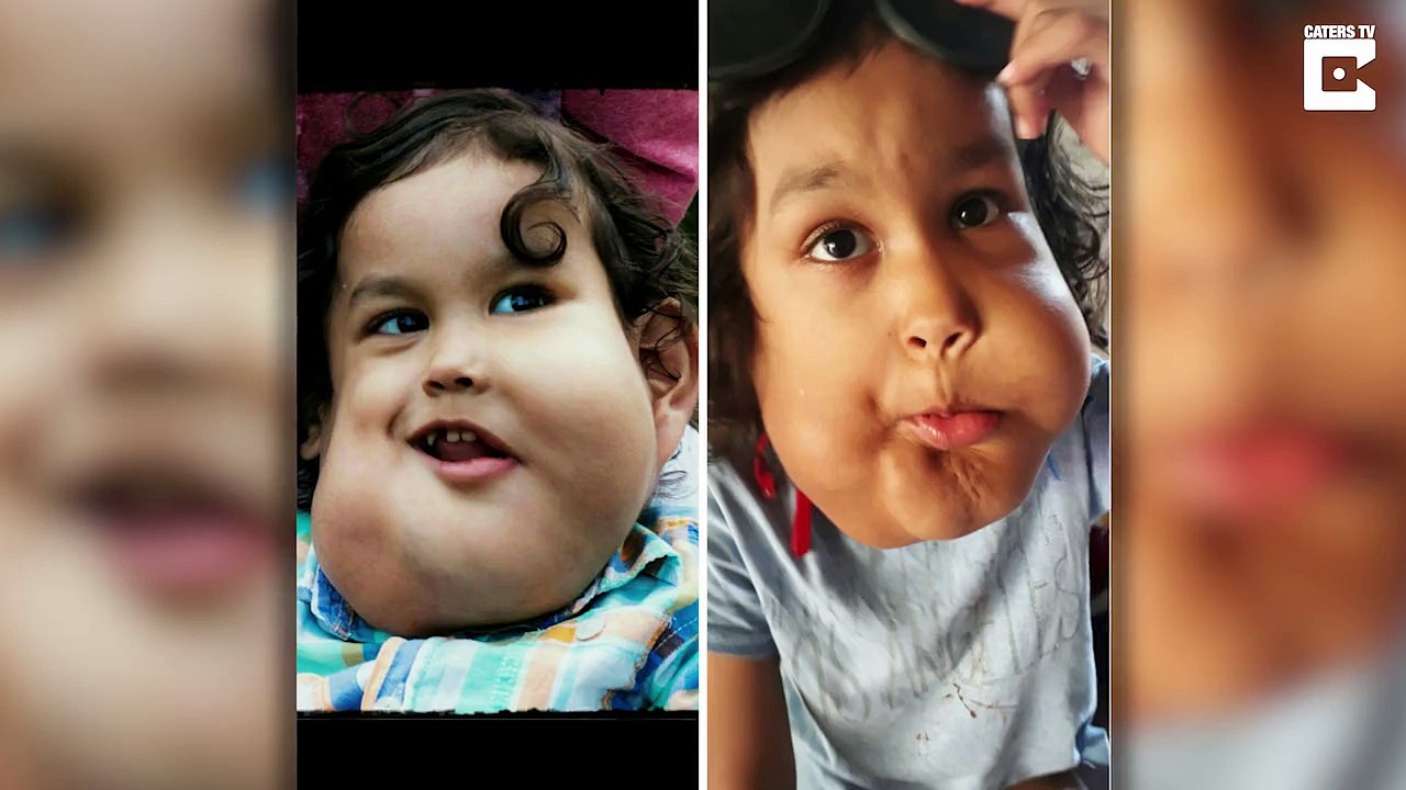 Brave boy battling massive watermelon size tumours in his face that