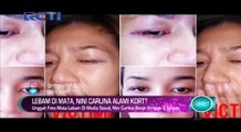 Lebam di Mata, Nini Carlina Alami KDRT?