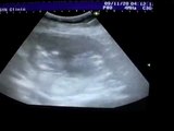 15 weeks 4 days ultrasound Boy or Girl?