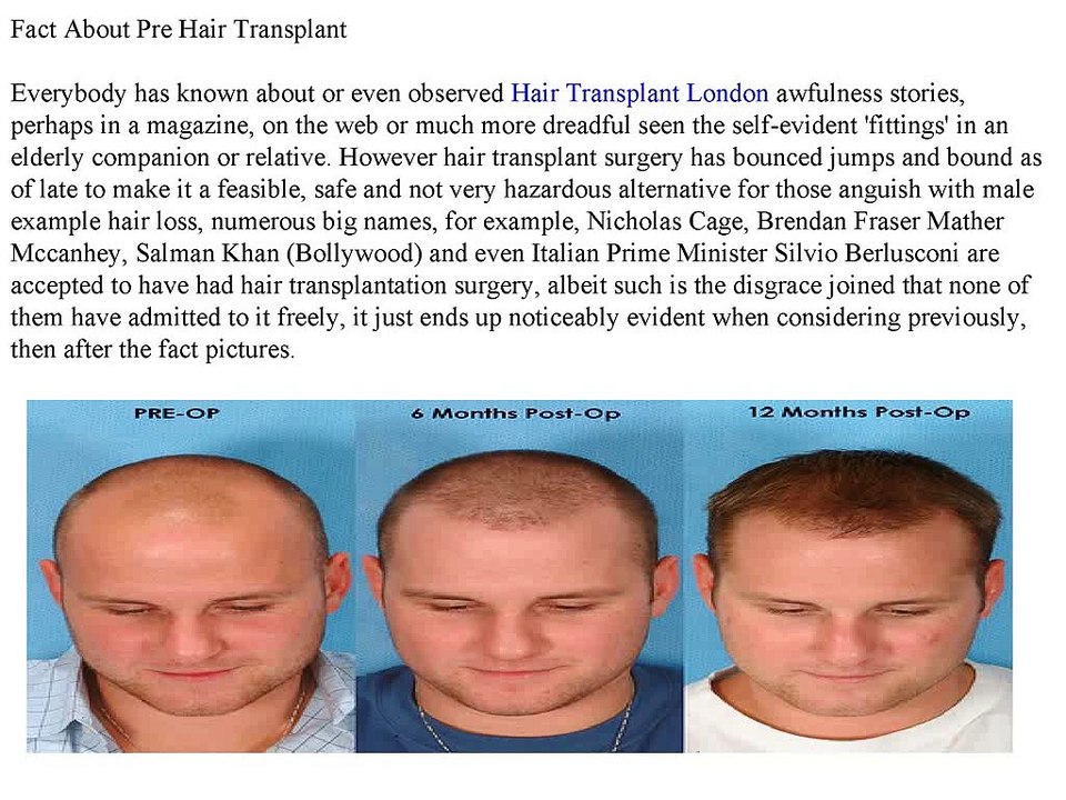Fact_About_Pre_Hair_Transplant