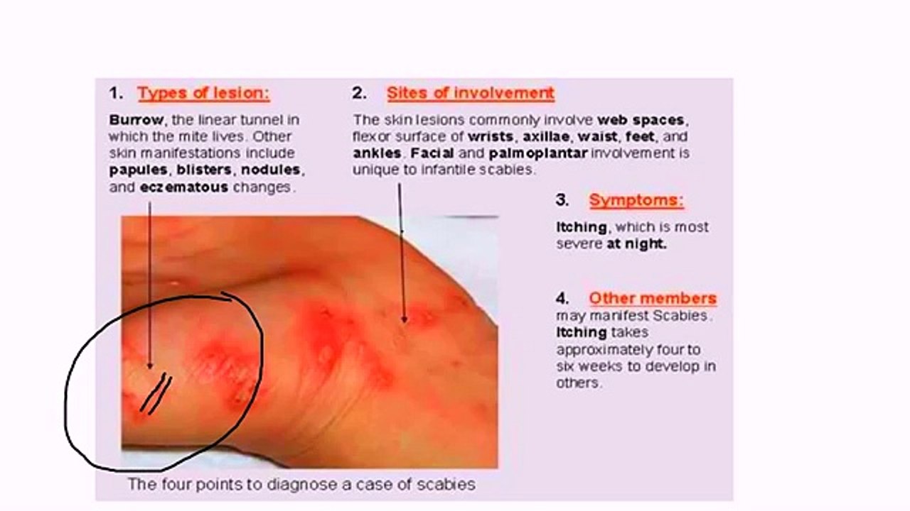 Scabies