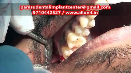 Wisdom Tooth Extraction Video _ Dentist in Chennai