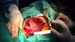 Open Heart Surgery is interrupted by MexicoÂ´s 09.19.2017 earthquake