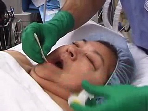 BAG MASK VENTILATION - Positive-Pressure Ventilation