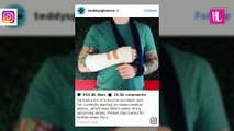 Ed Sheeran injured after cycling accident