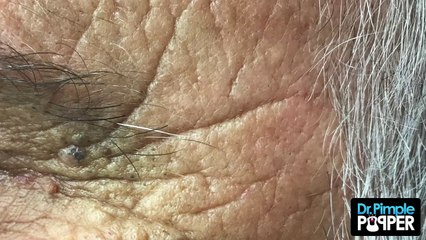 Favre-Racouchot Type Blackheads