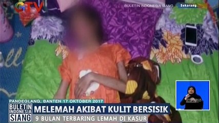 Derita Kulit Bersisik, Siswi SMK Keperawatan Ini Tak Bisa Lagi Bersekolah