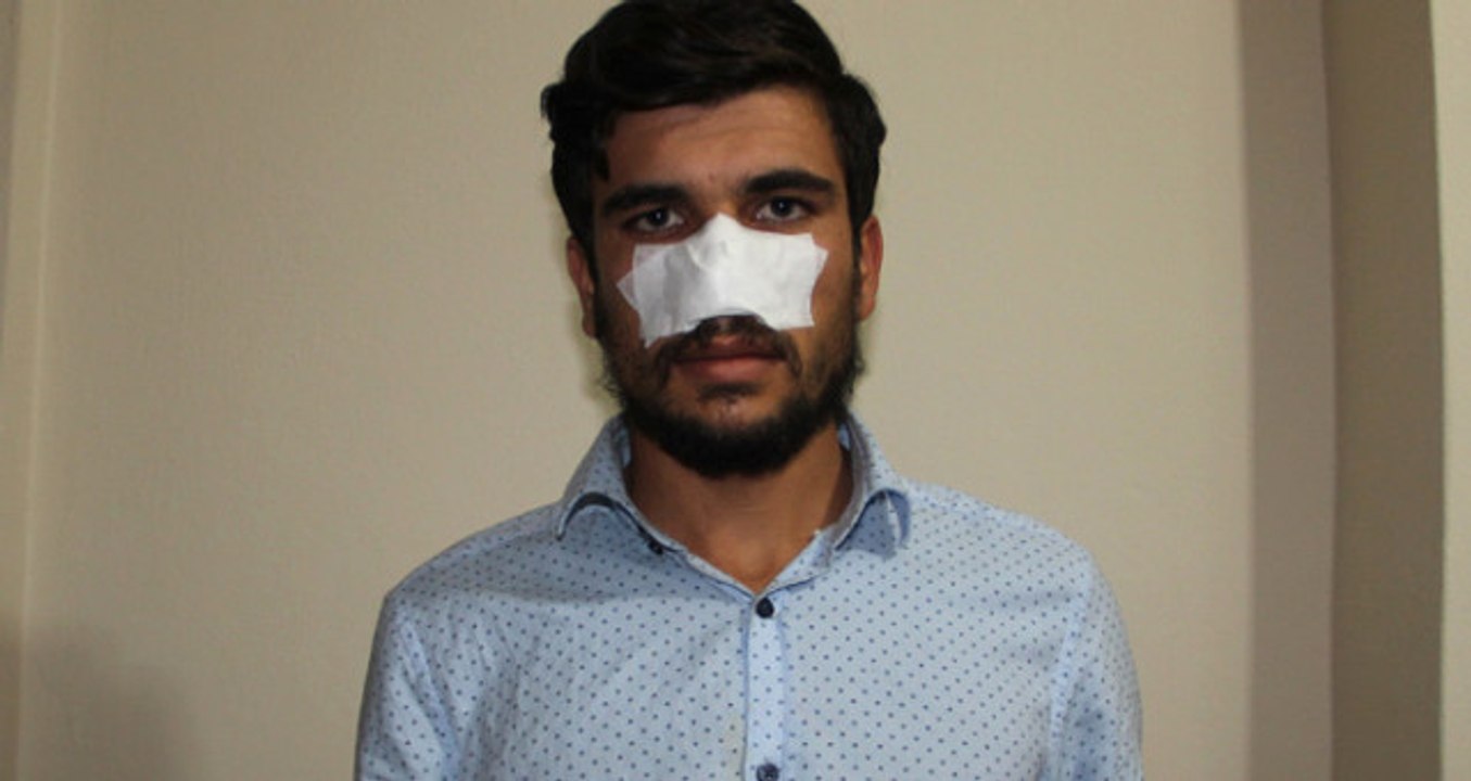 Kavga Ettiği Kuzeni Tarafından Burnu Koparılan Gencin Hayatı Kabusa Döndü