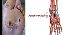 Diabetic Neuropathy Types, Symptoms, Prevention, Treatment