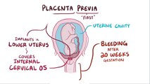 Placenta previa - causes, symptoms, diagnosis, treatment, pathology