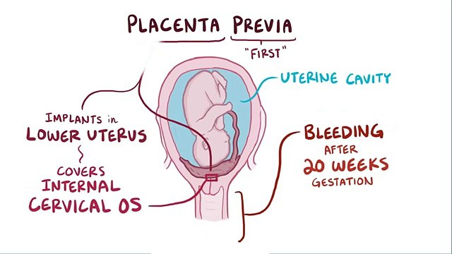 Placenta previa - causes, symptoms, diagnosis, treatment, pathology