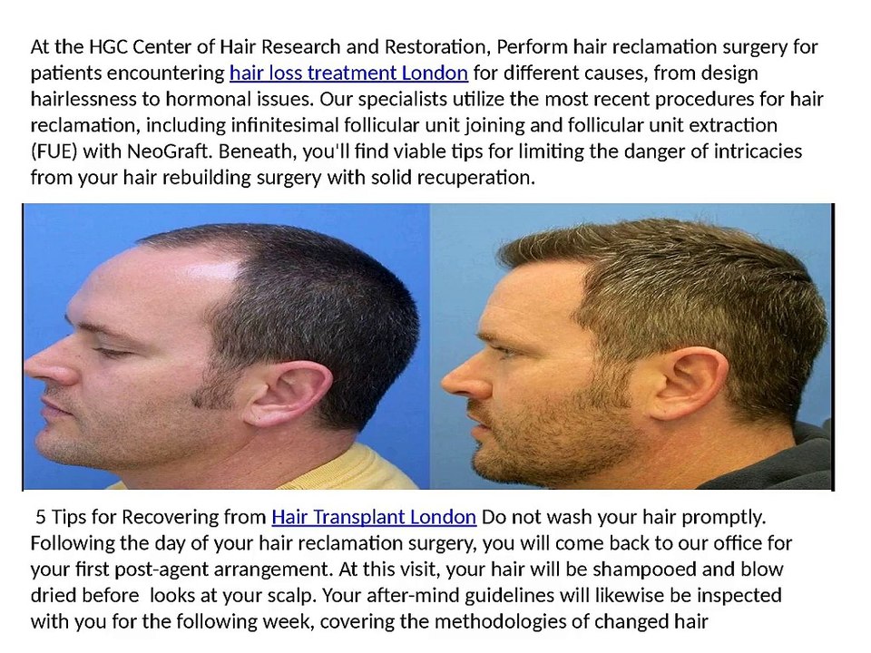 5_Tips_For_Recovering_From_Hair_Transplant