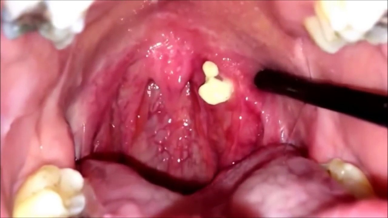 Tonsil stones removal BEST COMPILATION