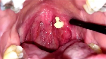 Tonsil stones removal BEST COMPILATION
