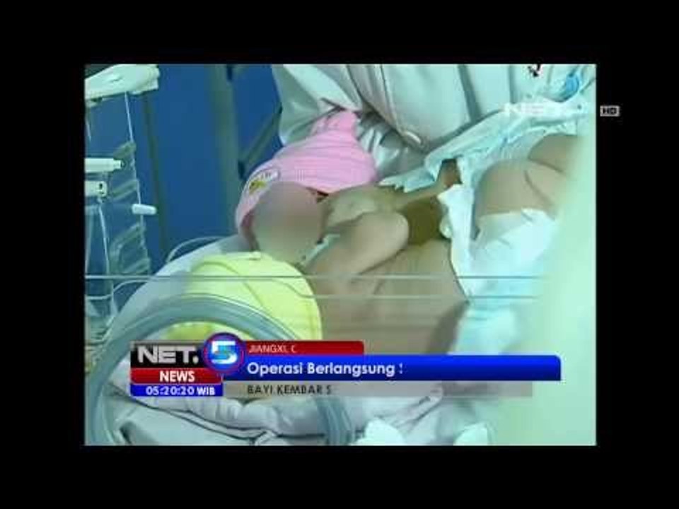 NET5 - Bayi kembar siam