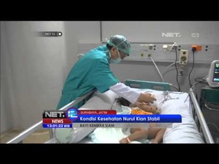 Kembar siam Nurul membaik dan siap dipindahan dari ICU - NET12