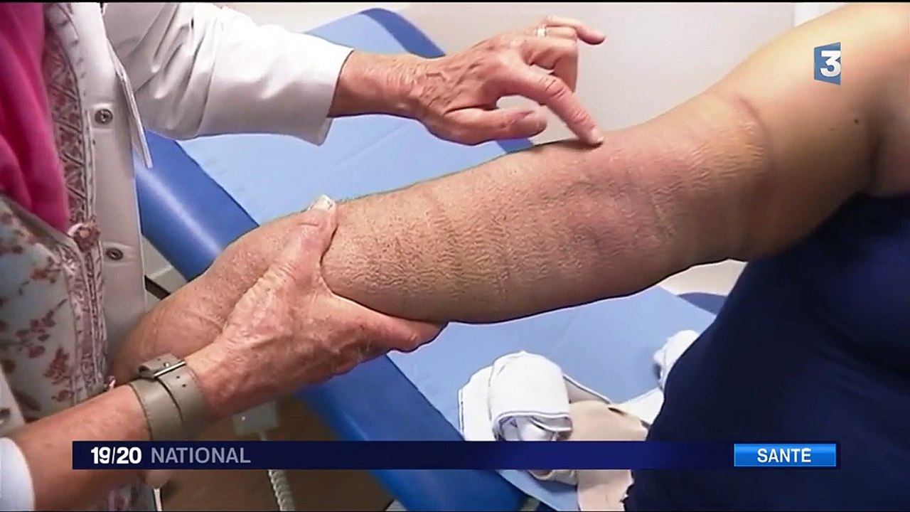 Cancer du sein : le traitement du docteur Becker pour soigner le lymphoedème