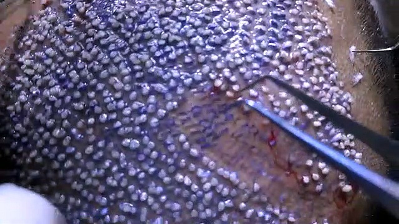 implantation