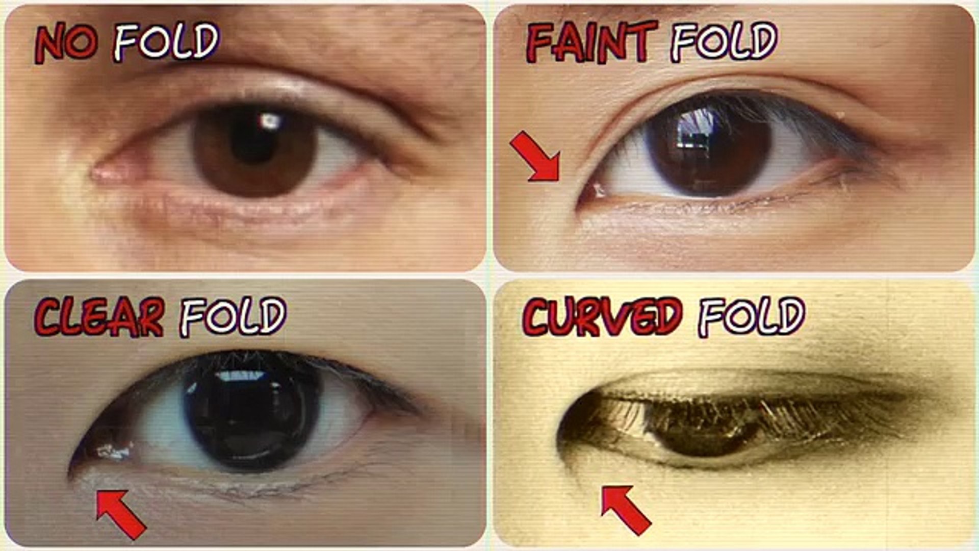 Epicanthal Folds Vs Normal | emsekflol.com